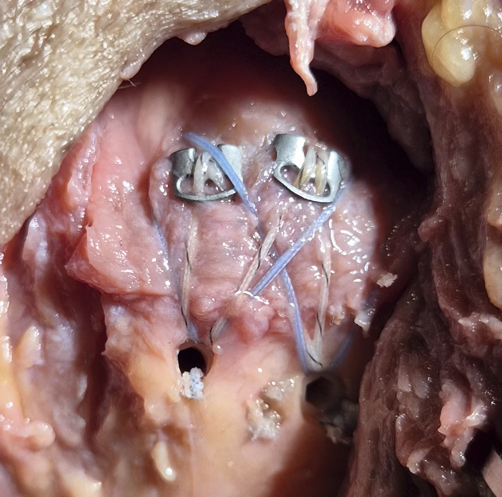 TENOGARDE™ eyelet implant in situ — surgical view