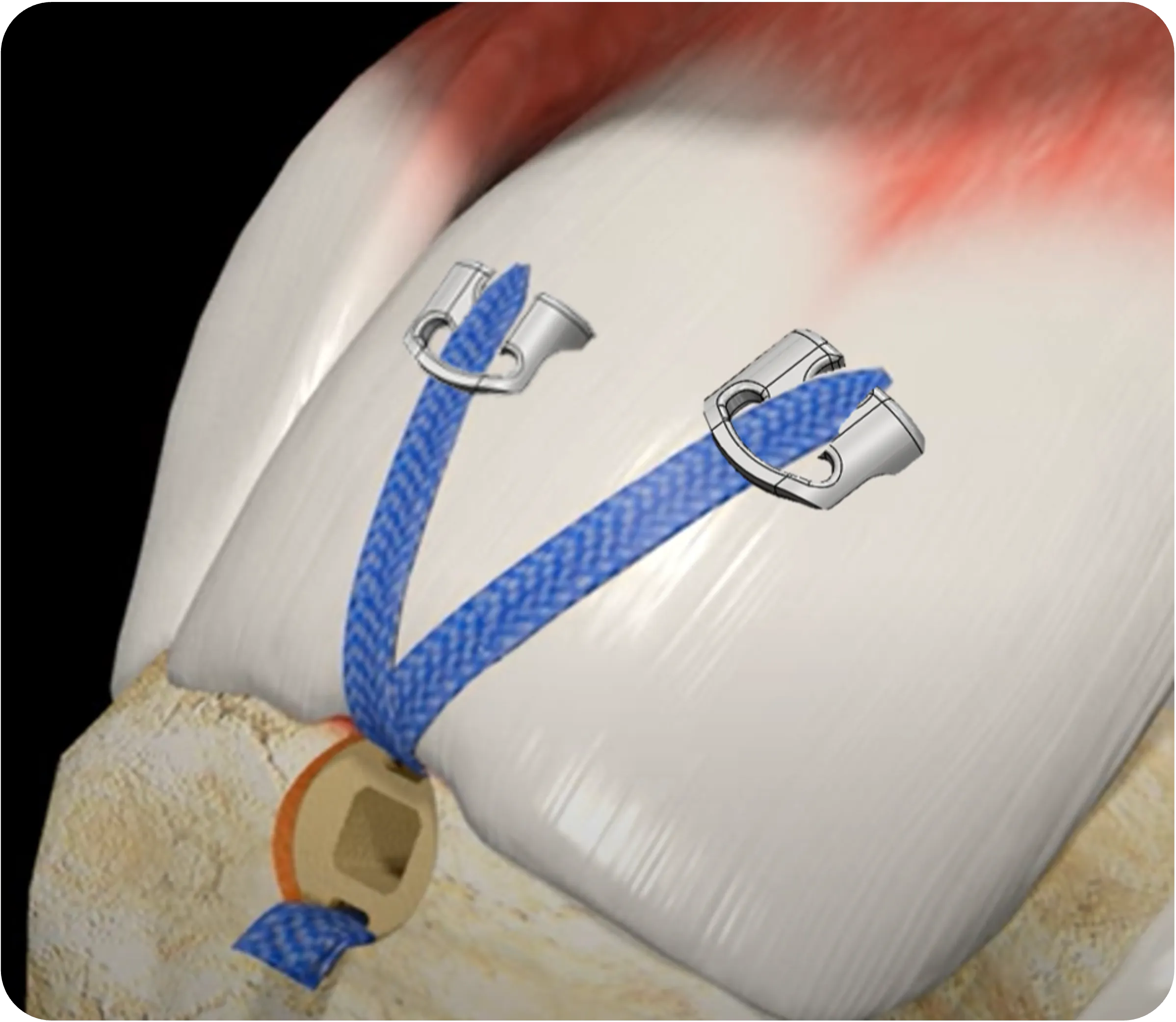 Single Row Repair with TENOGARDE™